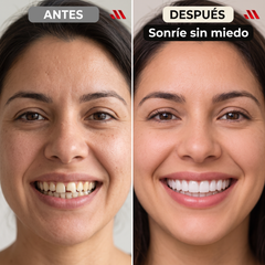 Carillas Dentales Premium — Sonrisa Perfecta al Instante